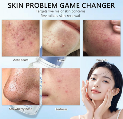 Pimple relief