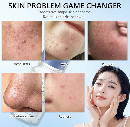 Pimple relief